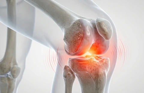 3D-Illustration eines arthrotischen Kniegelenks mit gerötetem, schmerzendem Gelenkspalt