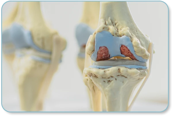 Arthrosetherapie